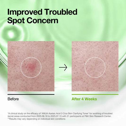 Anua – Azelaic Acid 3% Cica Skin Clarifying Toner (250 ml)