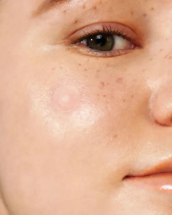 Isntree – Onion Newpair Spot Patch Skin Fit