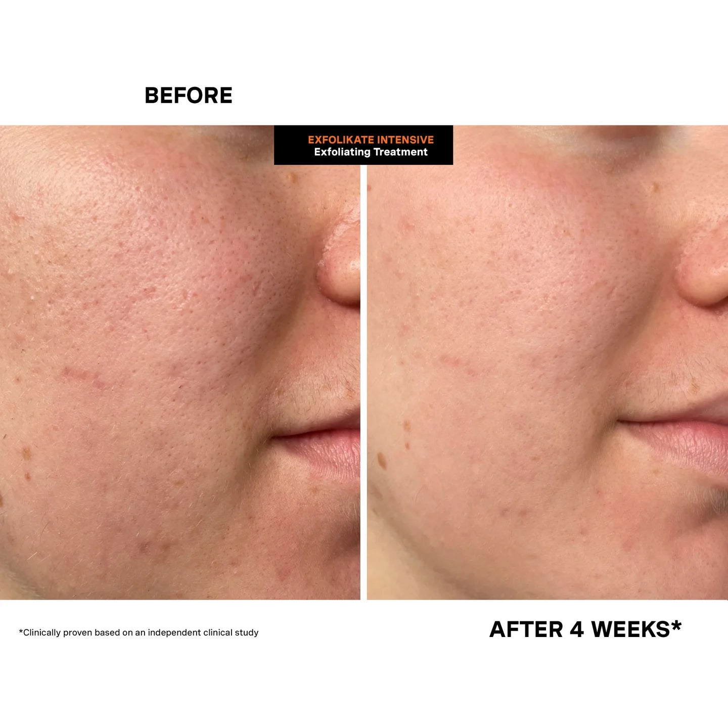 Kate Somerville – ExfoliKate Intensive Exfoliating Treatment [60 ml]